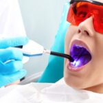 کاربرد لایت کیور دندانپزشکی