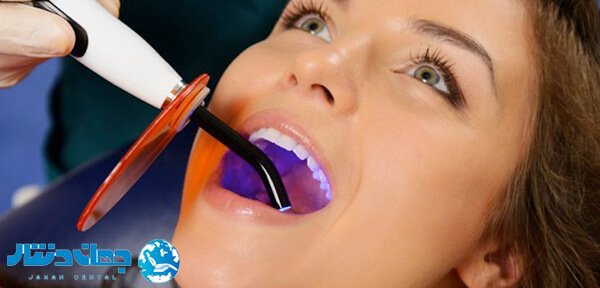 کاربرد لایت کیور دندانپزشکی